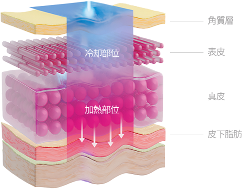 깊은 곳까지 열 전달 써마지 리프팅 추천